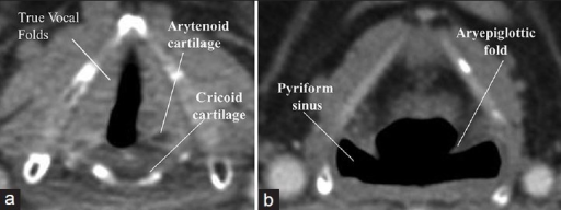 Aryepiglottic Fold Anatomy