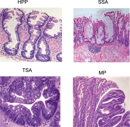 Types of serrated polypHPP, hyperplastic polyp; MP, mix | Open-i