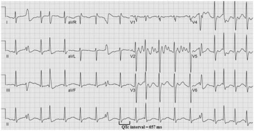 The 12 lead ECG without wide QRS tachycardia. This ECG | Open-i