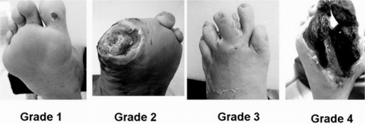Wagner Classification for diabetic foot.Grade 1, superf | Open-i