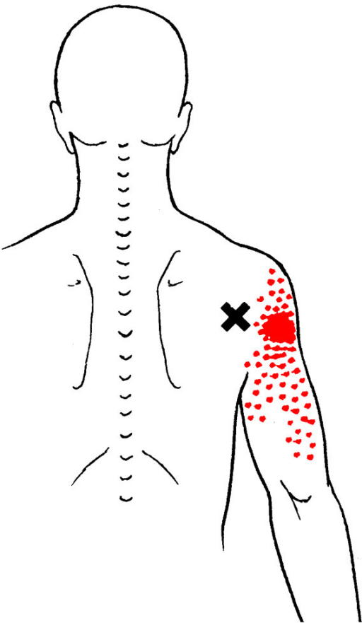 Referred pain pattern from teres minor muscle MTrP | Open-i