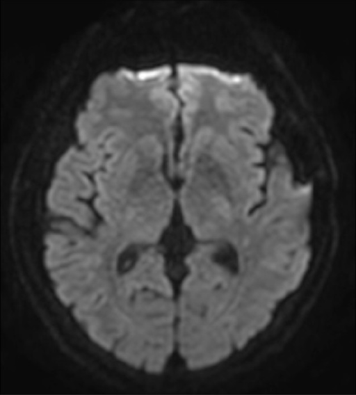 Diffusion MRI Scan At 25 Days After The Endovascular Treatment Patient Presented Intermittent Right Diffusion MRI Scan At 25 Days After The Endovascular Treatment Patient Presented Intermittent Right