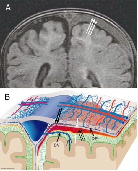 Left subdural compartment hemorrhage.Figure 5c panel A. | Open-i