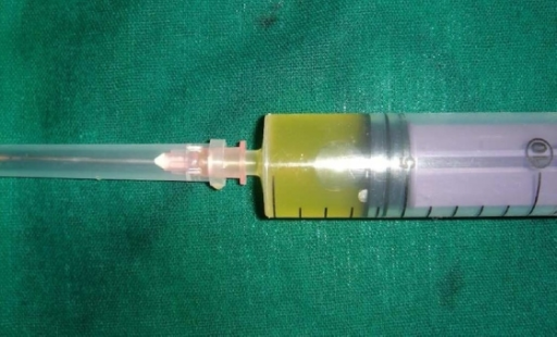 clear-straw-colored-fluid-aspirated-from-the-submandibu-open-i