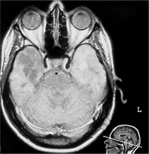 Herpes Encephalitis Mri Section Shows Bilateral Hyperd Open I