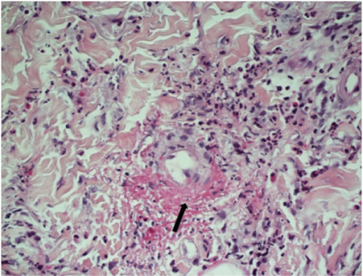 Skin punch biopsy showing features of leukocytoclastic | Open-i