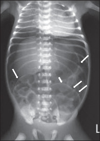 Arrows showing the Rigler sign in a neonate with massiv | Open-i