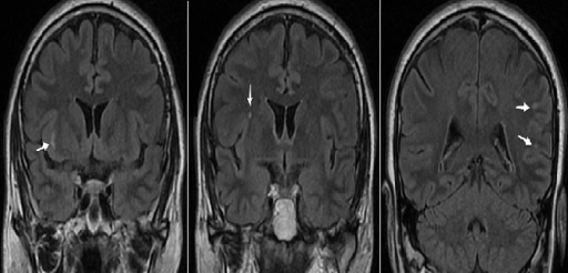 IRM cérébrale en séquence FLAIR chez le 2ème patient: L | Open-i