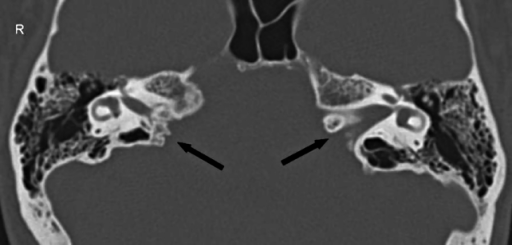 internal auditory canal segments