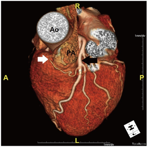 Fistula between proximal LAD and pulmonary trunk. Volum | Open-i