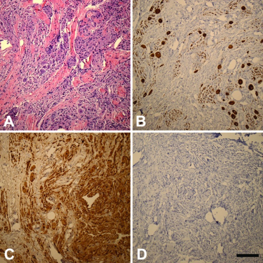 Immunohistochemical profile of ganglioneuroma highlight | Open-i