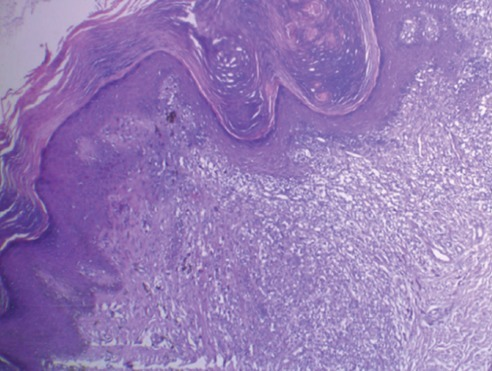 Hyperkeratosis papillomatosis and acanthosis - Jaja enterobius vermicularis leczenie