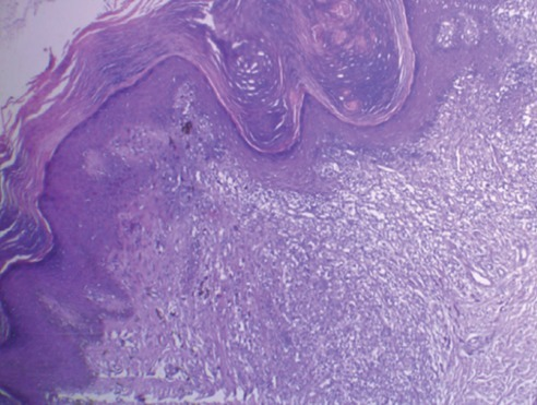 enterobius vermicularis histopathology
