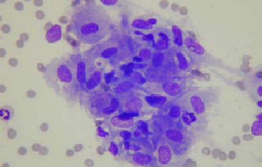 Granuloma-loose aggregates of epithelioid histiocytes | Open-i