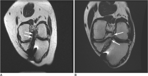 Grade 1 and 2 injuries in anterior cruciate ligament gr | Open-i