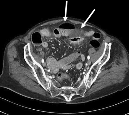 CT scan of abdomen  pelvis with evidence of free air  wit 