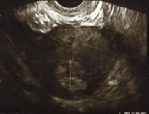 Col de l'uterus en image sur 32jours  Les févriettes 2011  Futures mamans  