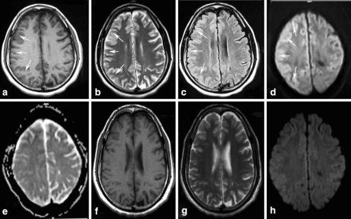 (a) T1-weighted axial MRI brain, reveals right cerebral | Open-i