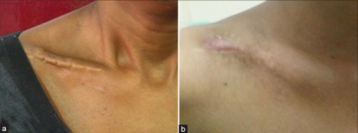 Clinical photograph showing complications of plating in | Open-i