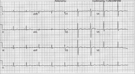 Preoperative electrocardiogram shows sinus bradycardia | Open-i