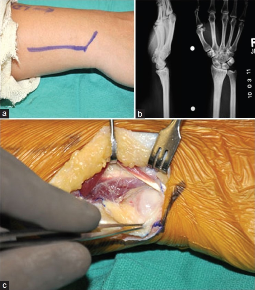 avanti ulna head prothesis Issuu is a digital publishing platform that makes it simple to publish magazines, catalogs, newspapers, books, and more online easily share your publications and get them in front of issuu’s millions of monthly readers. avanti ulna head prothesis Issuu is a digital publishing platform that makes it simple to publish magazines, catalogs, newspapers, books, and more online easily share your publications and get them in front of issuu’s millions of monthly readers.