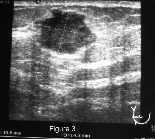 right-breast-ultrasound-from-a-35-year-old-patient-with-open-i