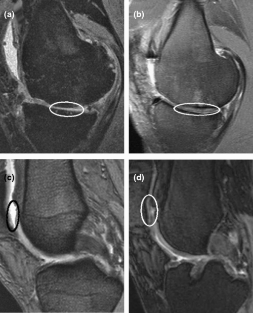 Magnetic resonance imaging (MRI) before and four years | Open-i