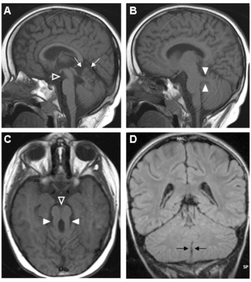 Brain MRI sections in patients with JSRD. A) mid-sagitt | Open-i