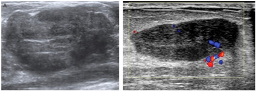 Fibroadenoma. (A) Aside from cystic lesion, fibroadenom | Open-i