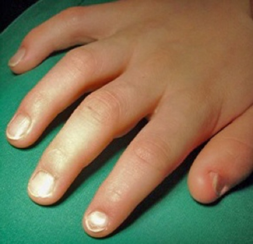 Nail-Patella Syndrome: A Classic Case | Dermatology Practical & Conceptual