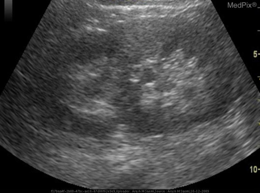 Coronal Ultrasound Image Of The Right Kidney Showing Absence Of Hilar coronal-ultrasound-image-of-the-right-kidney-showing-absence-of-hilar