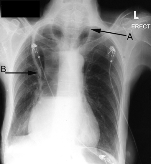 Chest X-ray demonstrating the presence of air-fluid lev | Open-i