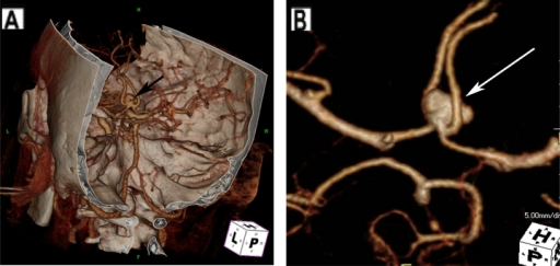 Anterior communicating artery (ACoA) aneurysm. (A) Cere | Open-i