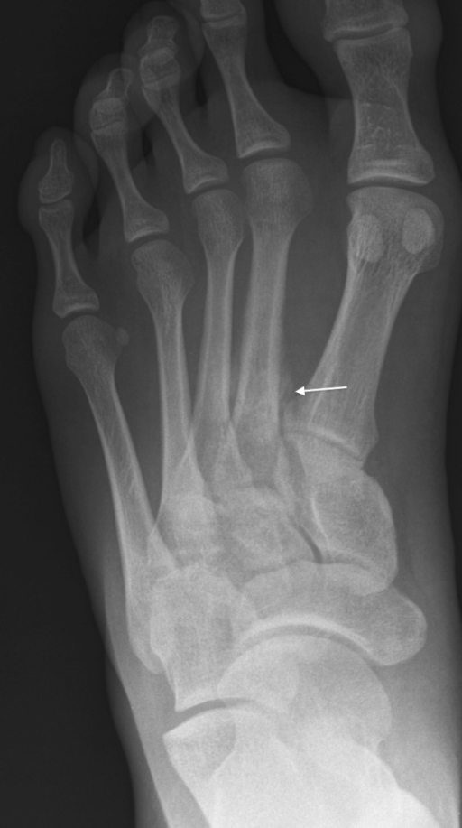 Plain film radiograph of 20-year-old patient with foot | Open-i