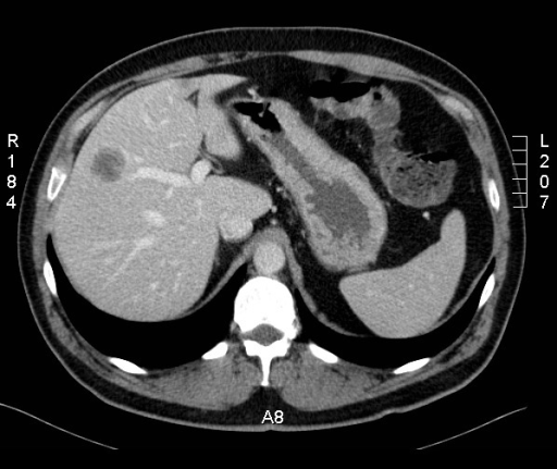 CT scan showing a solid liver tumor measuring ~3 cm | Open-i