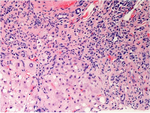 Interface hepatitis demonstrated by infiltration of lym | Open-i