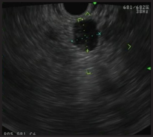 hypoechoic ultrasound