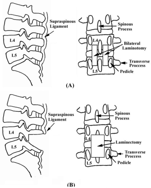 Lateral View and posterior view of lumbar spine after ( | Open-i