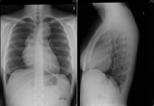 What Is A Chest X Ray Pa And Lateral