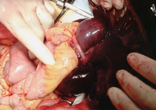small bowel strangulation caused an adherent band compo open i