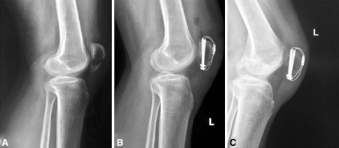 A 35-year-old man with a patellar fracture underwent fr ...