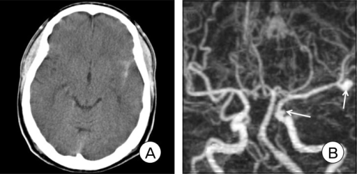 (A) Noncontrast-enhanced computed tomography (CT) scan | Open-i