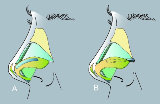 Lateral crural onlay graft (A) and lateral crural strut | Open-i