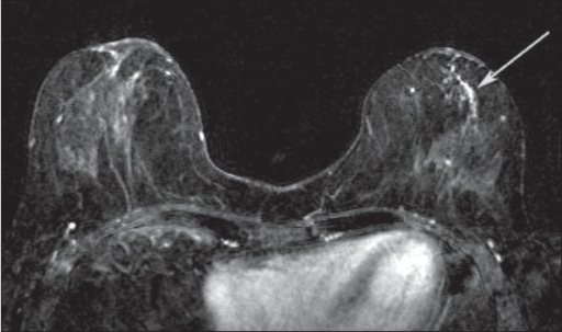 Axial DCEMRI subtracted image in a patient with a know  Openi
