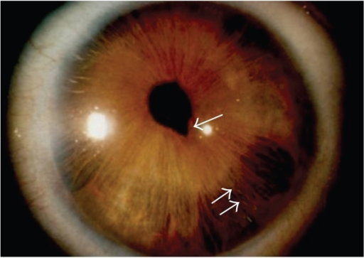 Corectopia (↑) and hypoplasia (↑↑) of the iris in | Open-i