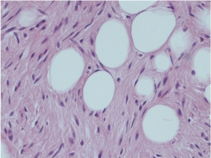 spindle cells and ropey collagen- found in spindle cell lipomas