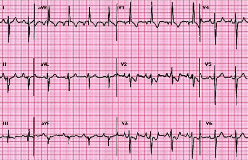 Electrocardiography in a case of pulmonary embolism: 95 | Open-i