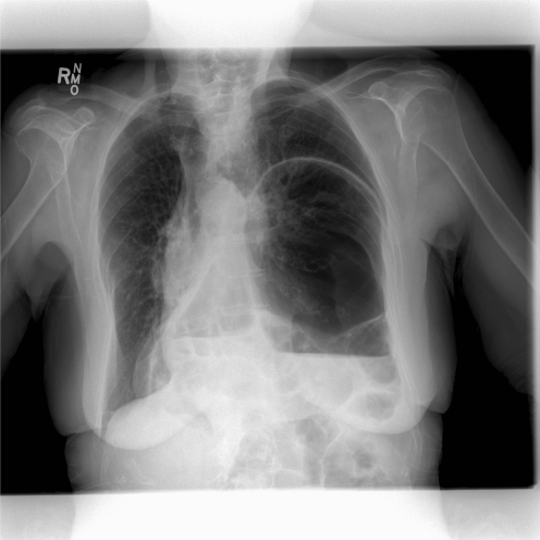 Chest X-ray revealing a large hiatus hernia with a dual | Open-i