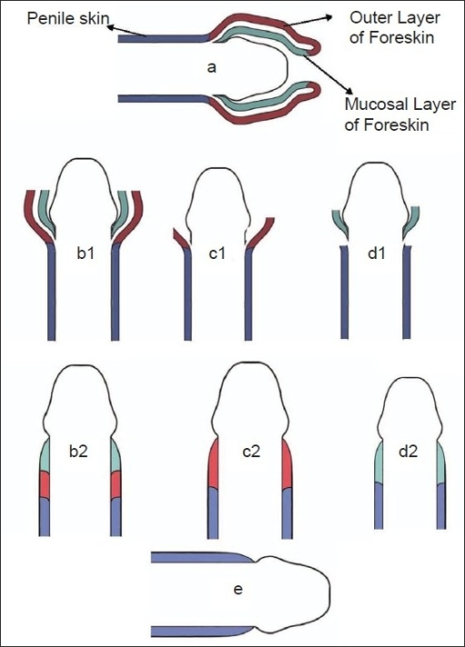 A Schematic Normal Anatomy Of Uncircumcised Human Fore Open I 