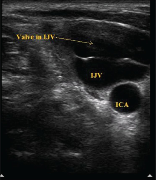 Ultrasound image showing large valve in internal jugula | Open-i